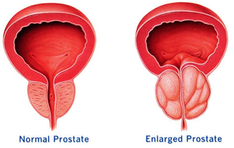 Prostate Problem Treatment